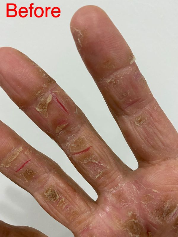 指や手のひらの皮が裂ける症状