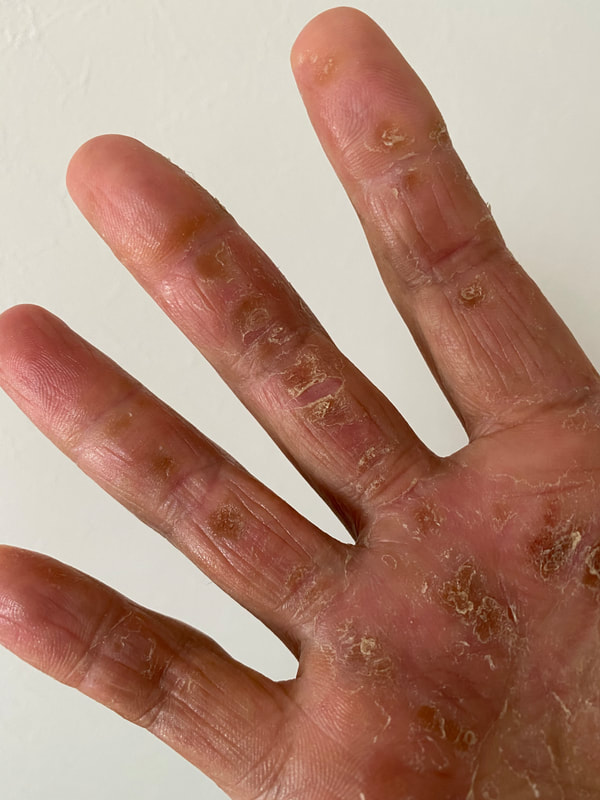 意識細胞光療法で指の皮膚の裂けが改善